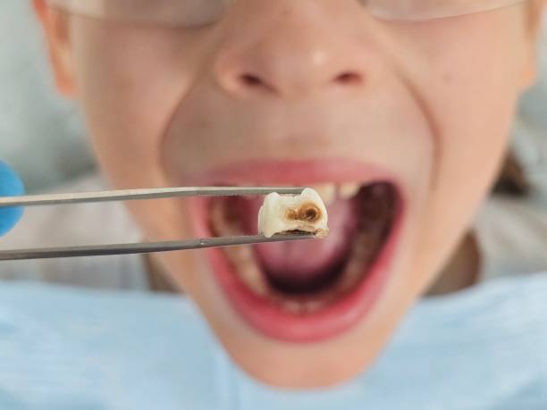 Best Emergency Tooth Extraction in Hudson, OH