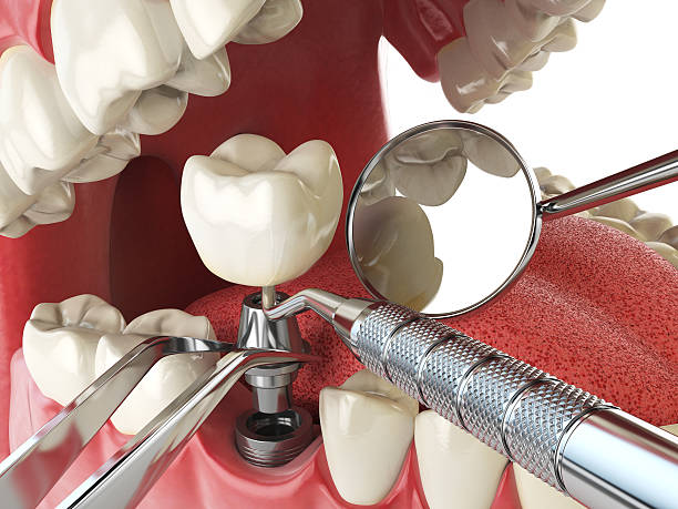 Best Emergency Tooth Extraction in Hudson, OH